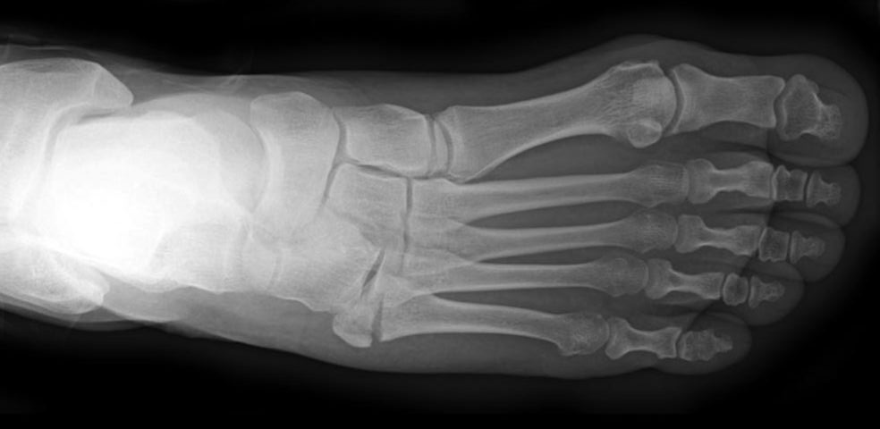 złamanie kości śródstopia